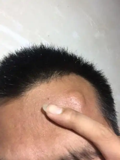 头上有个包,触感就像骨头一样的硬,不痛不痒的不知道是什么时候长的