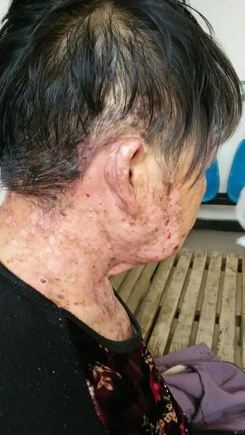 带状疱疹合并躯体单纯疱疹并发面神经炎一例 治疗过程 更新最新效果图