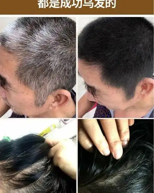 白发克星转黑发永久变黑神器中老年少白头防脱乌发液何首乌养发液中药