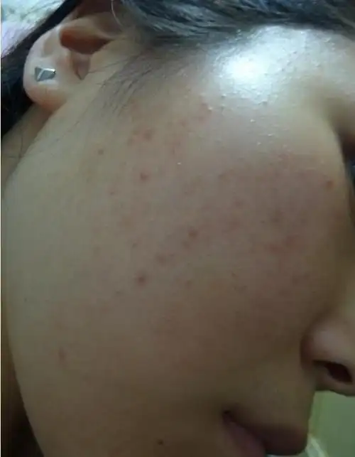 最常见9大粉刺痘痘肌肤问题看看自己有几样?教你怎麼正确的护理