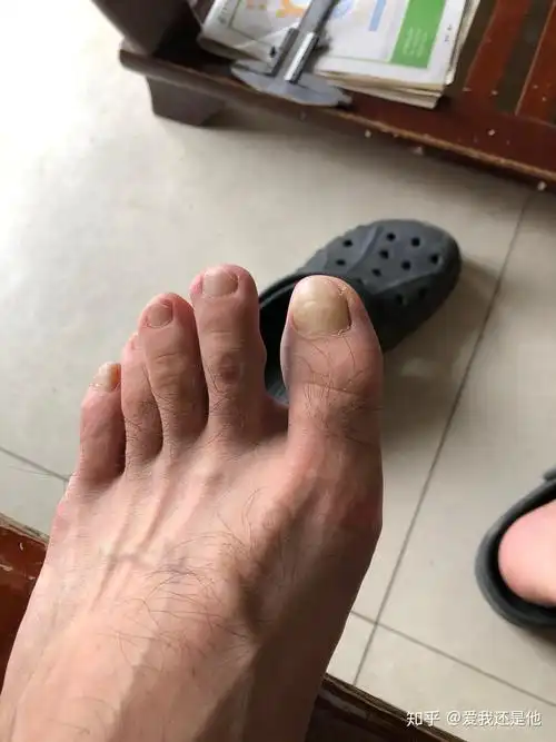 左脚的中指内侧关节处骨头突出这是骨质增生么有点担心啊有没有学医的