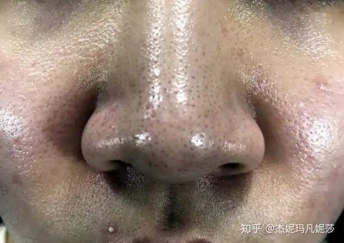 这种也是,皮肤油腻,角质层厚,建议去角质,去死皮,可以恢复小鲜肉