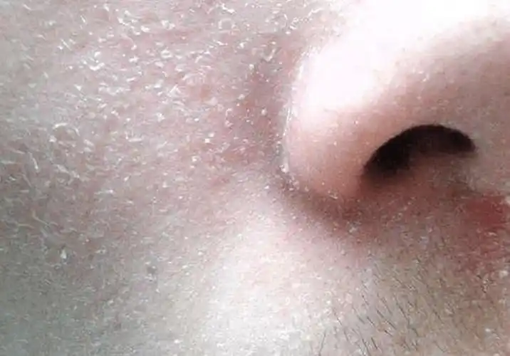 想要拯救干燥肌肤再怎么使用化妆品也只会黯然失色皮肤变得干燥起皮