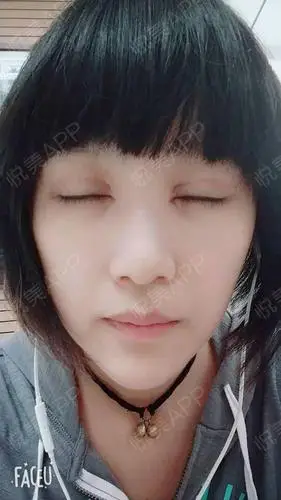 韩式双眼皮术后7天_全切双眼皮术后7天_双眼皮术后7天_眼部整形术后7