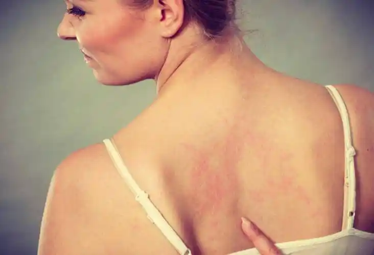 皮肤发痒是因为过敏吗?应该如何预防?_症状_进行_患者