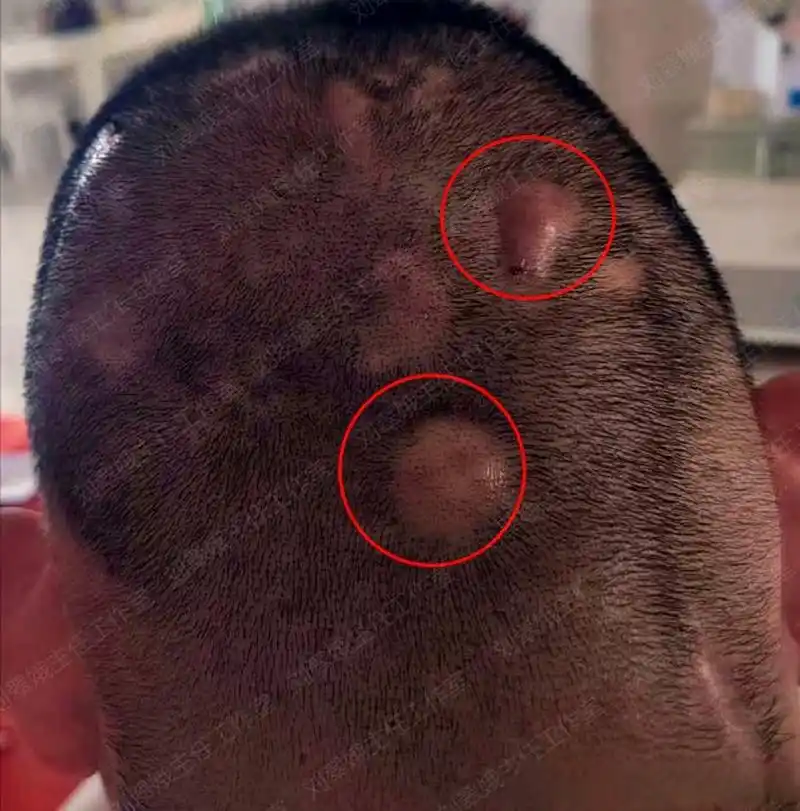 头皮长大脓包,中医解毒排脓,毛囊炎拿你没办法!