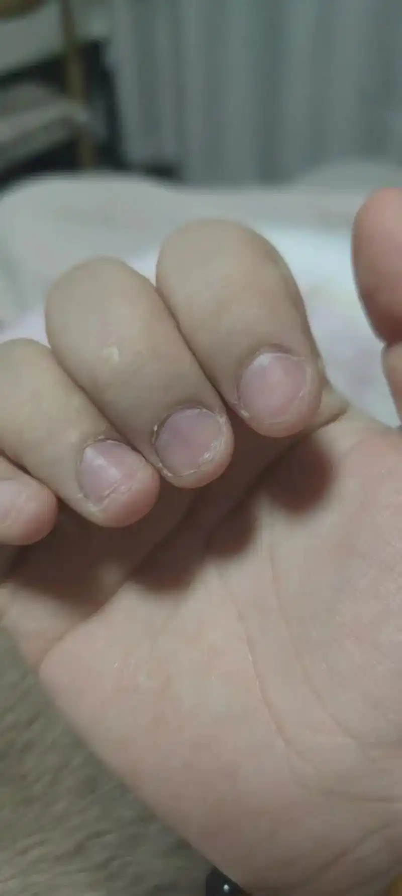 989898 爱啃咬指甲的宝子们,你们的手手还好吗? 很多宝 - 抖音