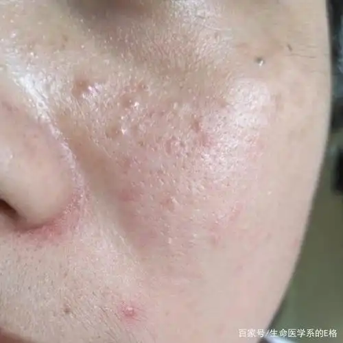 总是摆脱不了闭口?那你知道闭口是什么吗