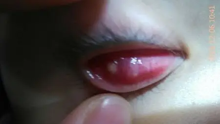 不到二周岁宝宝下眼皮内侧长了白色和粉刺差不多的东西,着急求解答