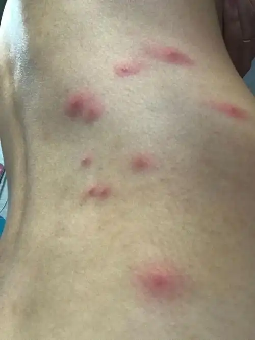 虫咬皮炎,学名丘疹性荨麻疹,和螨虫,蚊虫以及一些小昆虫叮咬导致过敏