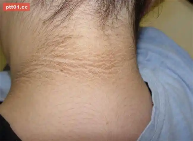 女性雄性激素过多如何正确调理以期取得长远效果