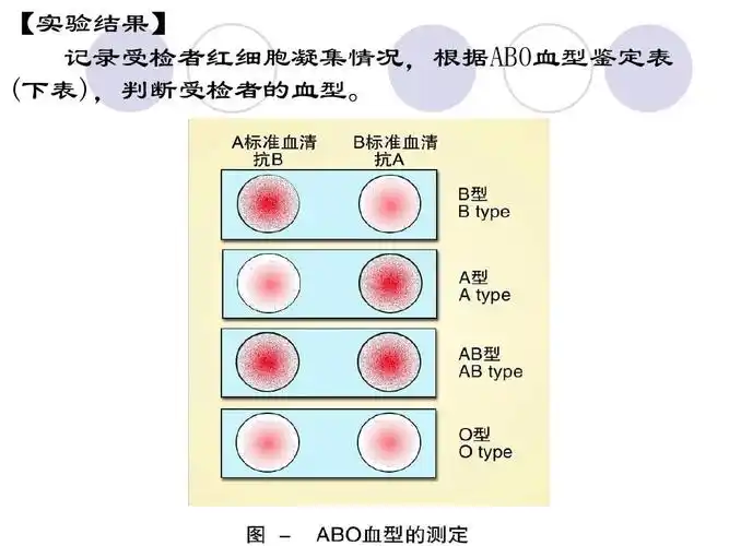 【实验结果】 记录受检者红细胞凝集情况,根据abo血型鉴定表 (下表)