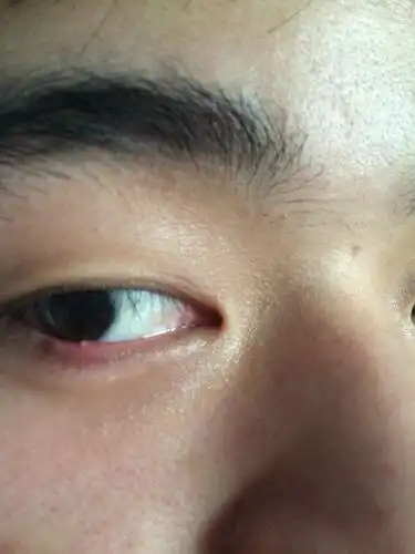 下眼皮出了个白色的疙瘩,要怎么把它消除了.