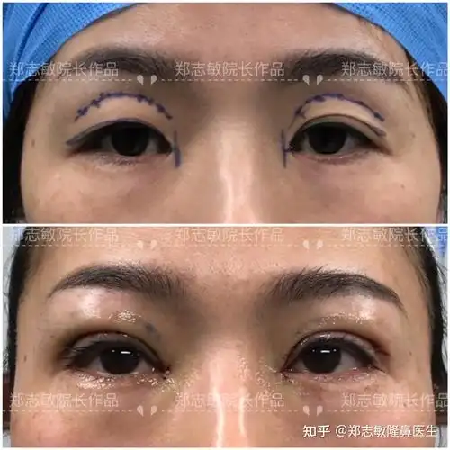 眼窝凹陷应该怎么样填充脂肪