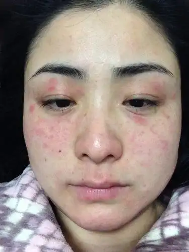 因为你对此产品过敏,你的皮肤可能是过敏性皮肤脸部过敏红肿怎么办1