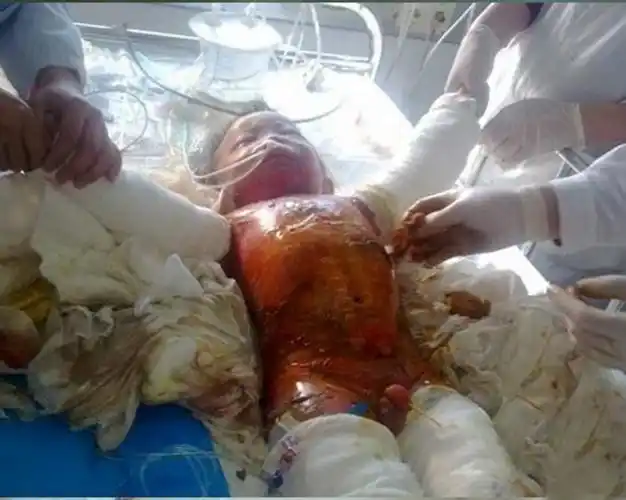 二级烫伤后恢复的图片_有来医生