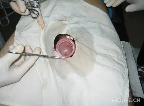 本人也尝试了一下,手术过程2分钟,无痛苦,新技术环切后较传统手术更