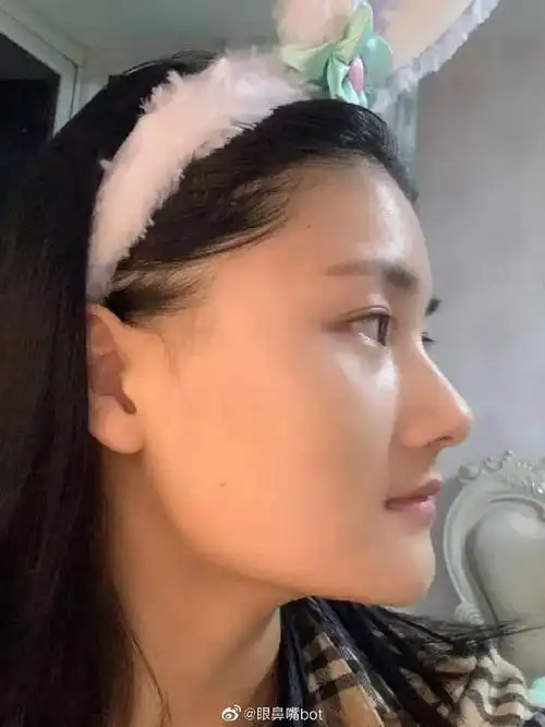 关节大,设计方案是长曲线下颌角术后效果:改善了侧脸突兀及下脸颊过宽