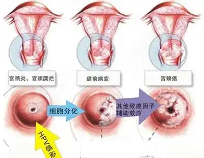 我国宫颈癌死亡率占总癌症死亡率的第四位,占女性癌的第二位.