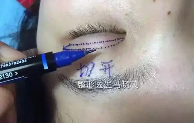 上翘为准,用画线笔在绷紧状态下设计一条与睑缘线类似平行的设计线