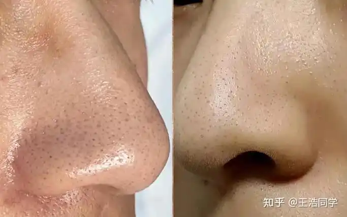 长满密密麻麻的黑头,脏脏的,毛孔也被撑大,男生怎么才能快速去黑头?