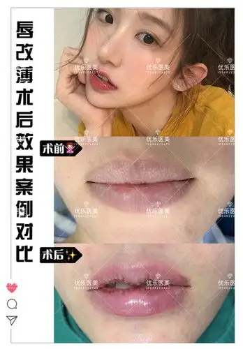 唇改薄术后效果案例对比