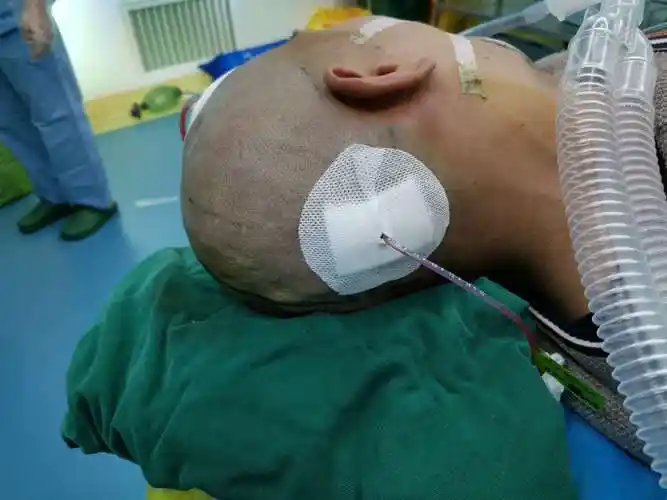 疫情期间黔东南州人民医院神经外科团队完成3例脑干出血手术