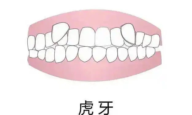 我是一颗虎牙,拔还是不拔?_治疗_位置_牙齿