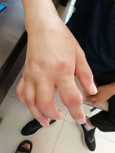 痛风患者服用桦褐孔菌的排痛风石纪实