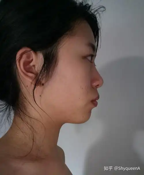 侧脸很平啊 怎么办啊 感觉脸就是一条线下去了 特别丑 眼睛近视还突
