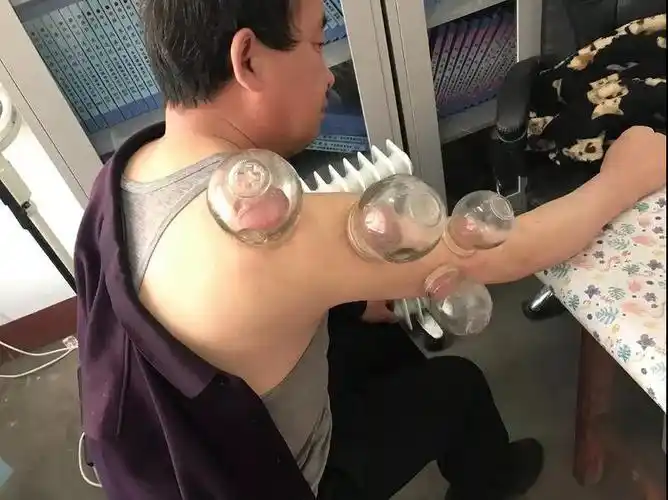 医务人员为一名肩周炎患者进行电针配合拔罐疗法进行治疗.