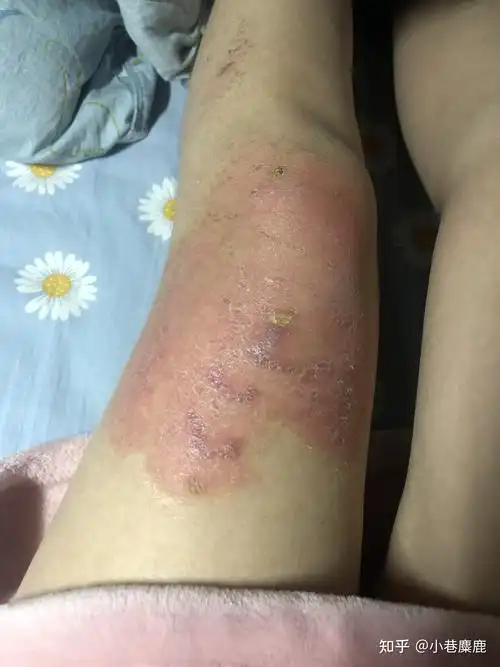 腿部被开水烫伤的恢复记录