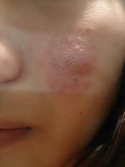 毛孔粗大 常堵塞粉刺又挤不出来 求大师改善痘痘皮肤的方法!