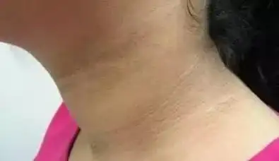 脖子突然长了一个黑色的痣