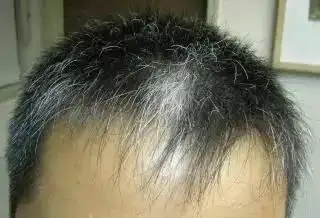 白发长在哪病就在哪出长在前额两鬓后脑勺分别代表什么