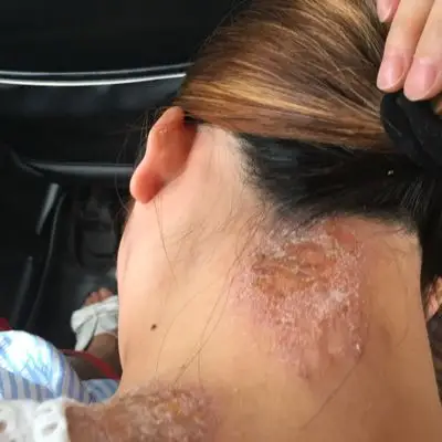 我现在怀孕六个月了,可是脖子上长满了藓,请问能擦药吗?