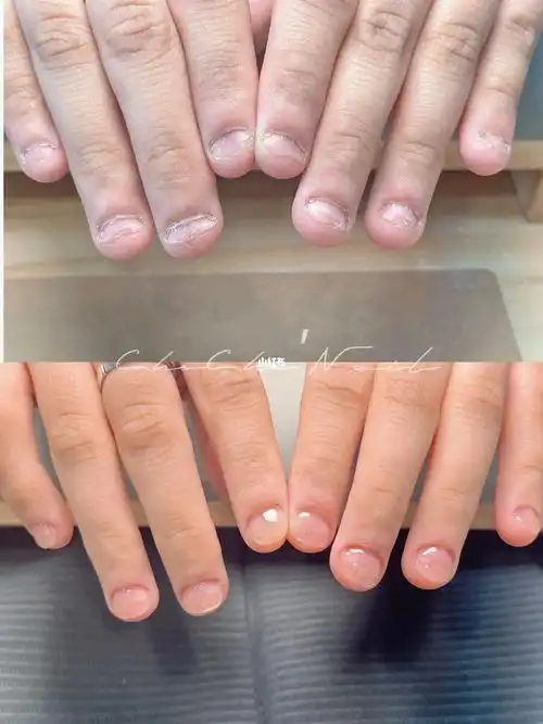 啃咬甲两个月后变化