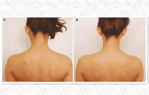 瘦肩针管用吗 对斜方肌真正发达的人才更有用-美丽秘诀网