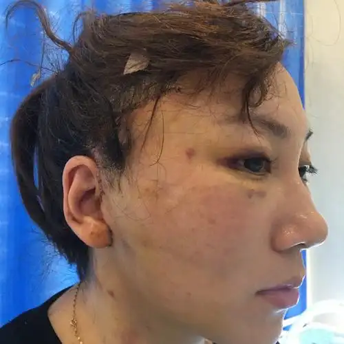 拉皮 术后第七天,能够看到皮肤这几天变得越来越好了,才做完手术的