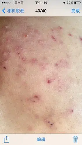 问:屁股上长的刺挠,这是啥病