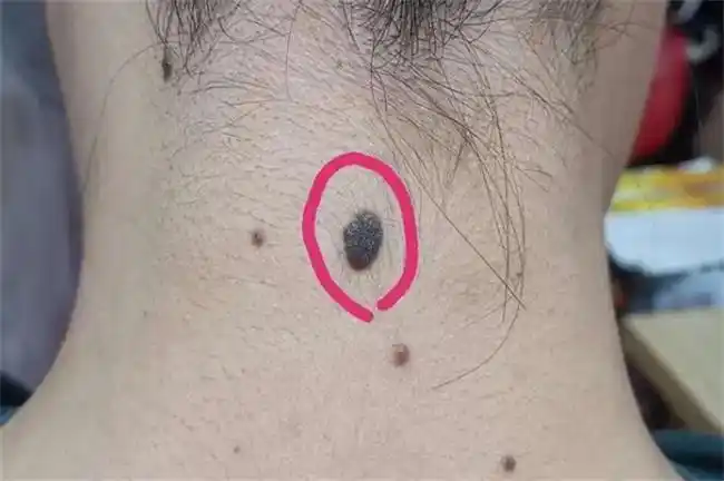 也有可能会一夜暴富让自己过上衣食无忧的生活,而且背后有痣的女人在