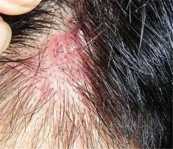 男童头皮毛囊炎康复图片_有来医生