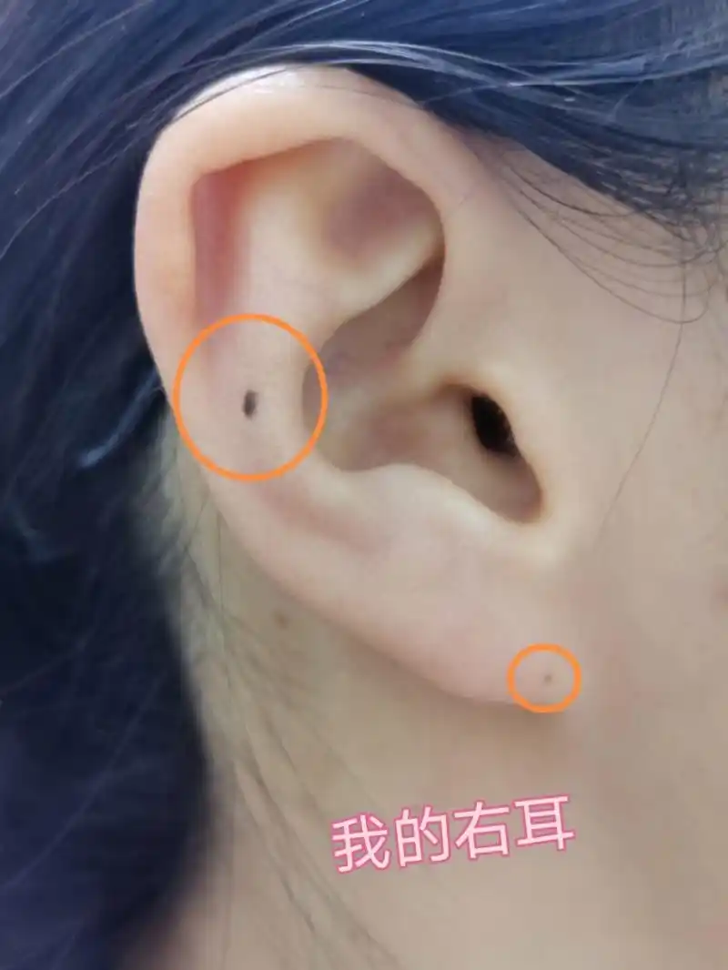 耳朵有痣是吉痣,看看是什么福气吧7715 长在耳朵上的痣,大致分为
