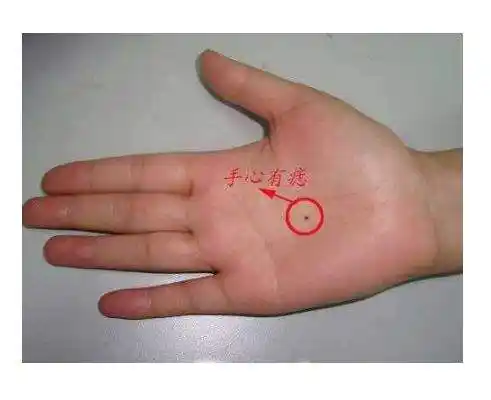 女人长痣巨富痣有哪些:分享女人巨富痣和大福痣