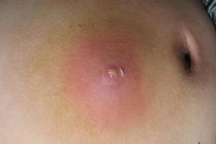 毛囊炎,初起损害为略微隆起的红色疼痛小结,迅速发展成半球形坚实结节