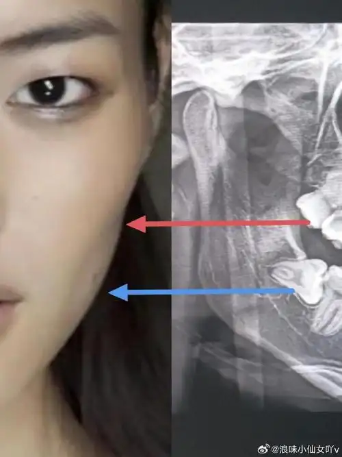 拔完智齿会面部凹陷吗