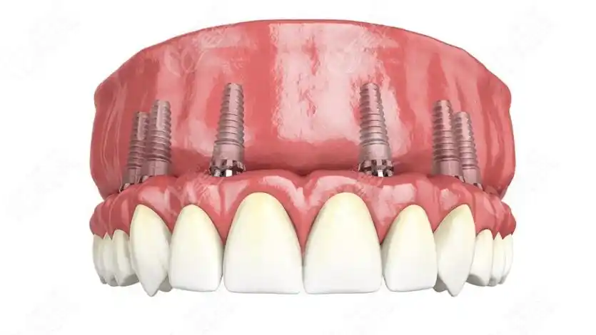 半口种植牙价格表www.236z.com