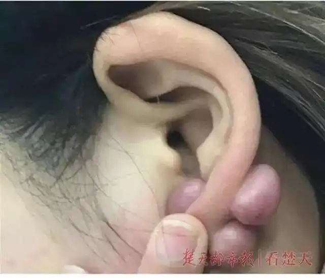 女生双耳长出6个大肉疙瘩只因打了耳钉医生没注意这点就会长