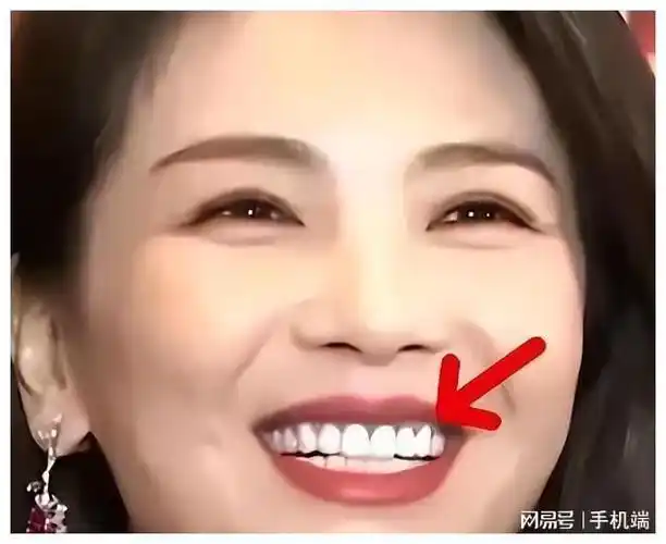 嘴凸,牙龈发蓝变黑,做烤瓷牙的"刘涛"们,后遗症都慢慢显露了