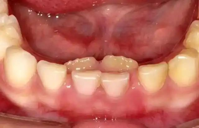 双排牙又叫做"乳牙滞留",最常出现在处于换牙期的孩子嘴里,那么,究竟